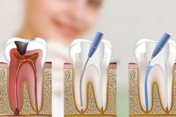 endodoncia_new